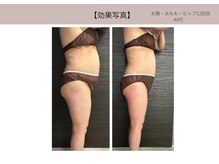 ミライ 福岡筑紫野店(mirai)/お腹、太ももヒップ