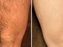 ウルル(Ululu)の雰囲気(メンズ専門脚脱毛脚脱毛ビフォーアフター)