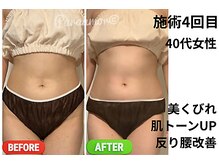 パラアモール(Paraamor)/フェムケア施術4回目