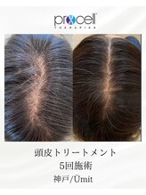 ユミト(Umit)/プロセルスカルプ