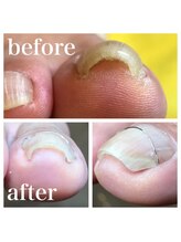 ドクターネイル爪革命 北千住店/巻き爪ケア