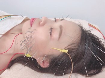 ユウビビューティサロン 東生駒(Yuubi Beauty Salon)の写真/【憧れの小顔に◎】鍼施術で目元ぱっちり/お顔周りがすっきり!!小顔を叶えつつ、お肌のお悩みも改善☆