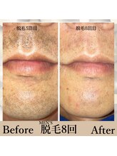 ノーブル(Noble)/メンズ ヒゲ脱毛 8回 効果実績