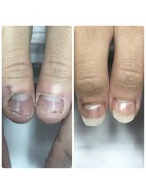 エルナ(elna)/自爪風深爪矯正