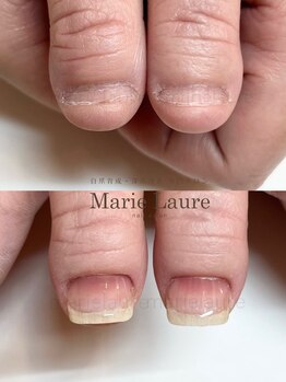 マリーロール 梅田店(Marie Laure)/深爪矯正/自爪育成/自爪風