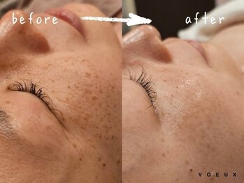 ボウ 静岡本店(VOEUX)/シミ・しわケア 6回