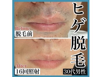 ツバキ(TSUBAKI)/ヒゲ脱毛