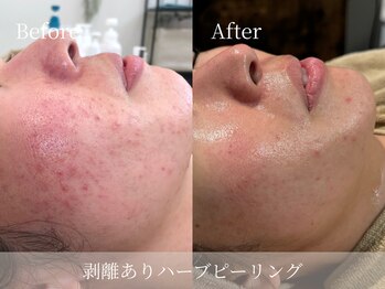 ルミセル(LUMICEL)/開き毛穴・ニキビ肌の変化