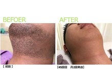 モーイエンチャーム(mooi en charme)/ヒゲ脱毛