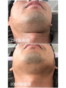 ナンバー511(No.511)/ヒゲ脱毛