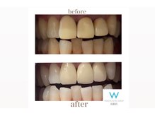 ホワイトニングショップ 島根店/Before&After美白ホワイトニング