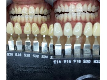トウキョースワーズ 渋谷店(TOKYO SWRS)/#ホワイトニング #渋谷 #池袋