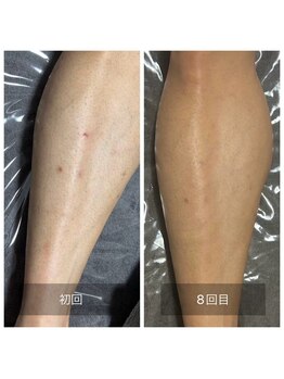 ダンニヒル(dannihil)/筋トレ×脱毛