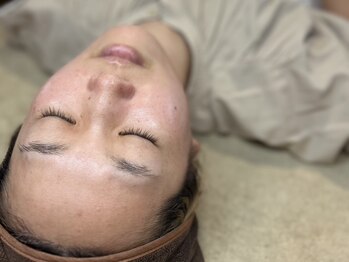 リエート(Lieto)の写真/【本気のニキビケア・シミケア】リピート率９０％以上の≪ドライピーリング≫で、つや肌に導きます♪