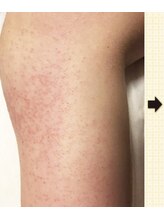 ノットノット 自由が丘(Not Knot)/１.グリーンピールボディ 施術前
