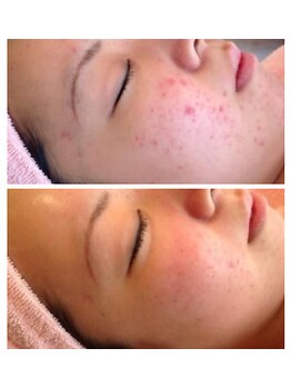 レクラ バイ ドクターエイチ(L'ECLAT by Doctor.H)/ハーブピーリング