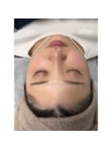 小顔・痩身専門店Lift（リフト）練馬/小顔専門店Lift|Before After
