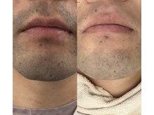 メリアミーゴ(Meli amigo)/メンズ脱毛