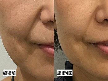 ルナ クレッシェンテ(Luna crescente)/年齢の出やすい口元の悩み解消