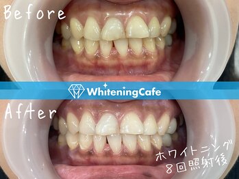 ホワイトニングカフェ 名古屋栄店(WhiteningCafe)/8回照射症例写真