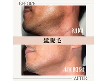 サロン ド カスケード(Salon de Cascade)の雰囲気（青髭脱毛。自己処理による肌荒れニキビ乾燥にさようなら！）