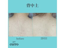 アクト クロ(ACT curro)/【背中上】脱毛施術例