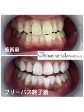 ホワイトニングサロン 京都烏丸店/ホワイトニング施術例