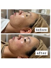 クリア 栄生(CLEAR)/《ビオフィート》施術直後