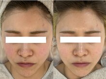 ビスキン(BeSkin)/毛穴・赤み・乾燥メニュー