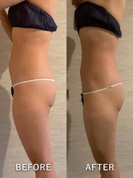 オーロラ(Aurora)/痩身ダイエットコースの1回目