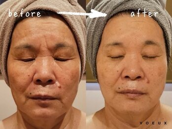 ボウ 静岡本店(VOEUX)/眉間のしわ 6回