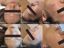 サロンデュ ひゃーく(Salon du ひゃーく)の雰囲気(陶肌トリートメント:大人気のニキビ肌改善メニューです)