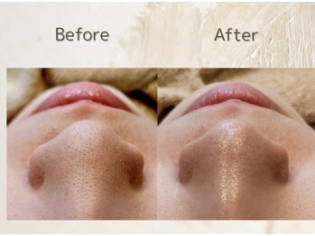 アンダブル(Andouble)/小鼻の毛穴ケア