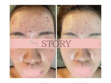 ニキビケアはハーブピーリングでどんどん美肌に♪毛穴／シミケア