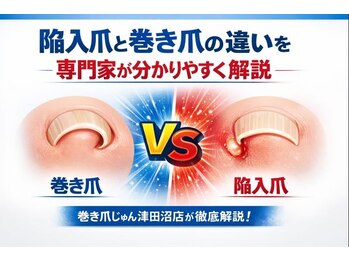 巻き爪じゅん 千葉駅前店/陥入爪について専門家が解説