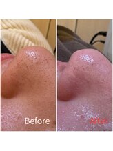 モアビューティー 紙屋町店/毛穴、大洗浄