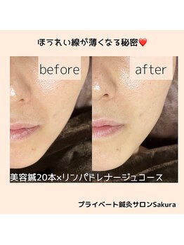 サクラ(Sakura)/美容鍼×ドレナージュコース