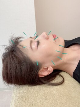ヒーリングサロン アージュ(A-je)/★美顔鍼＋小顔矯正★