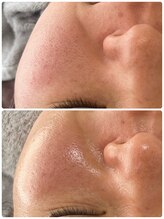 ナナラ(NANALA)/ちゅるちゅる・お肌