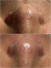 スパークル/毛穴/脱毛/毛穴洗浄/ワックス