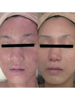 ホワイトアクア 梅田本店(WHITE AQUA)/ララピール/大阪/梅田/毛穴/小顔