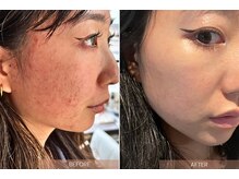 ラフバイディアブルー(Laugh by diarblue)/クリスティーナ　ピーリング