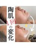 【シミ・くすみ】くすみゼロの大人美肌へ!ハーブピーリング/ オプション付き