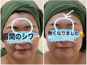 リマインド(ReMind)/眉間のシワ