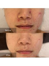 マインエム(mine.m)/リバウンドニキビ