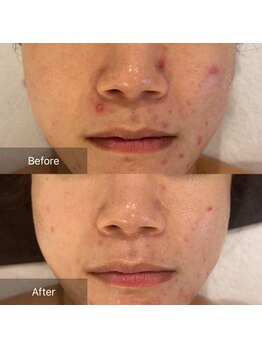 マインエム(mine.m)/リバウンドニキビ