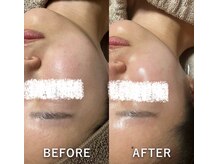 リュミエール(Lumiere)/毛穴洗浄結果