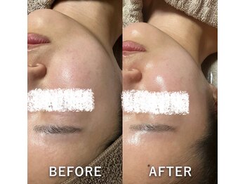 リュミエール(Lumiere)/毛穴洗浄結果