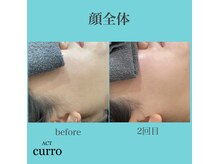 アクト クロ(ACT curro)/【顔全体】脱毛施術例