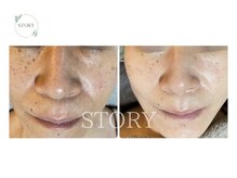 ストーリー 岐阜店(STORY)/ハーブピーリング専門店STORY